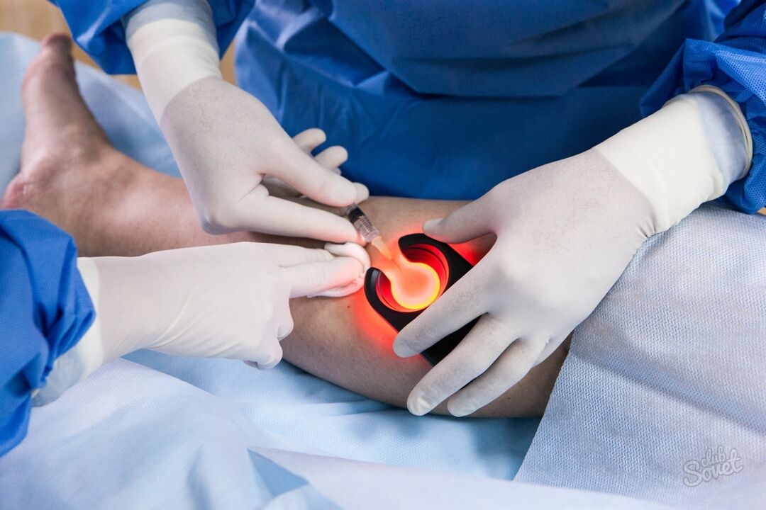 Vene varicose sulla diagnostica delle gambe