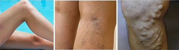L'aspetto delle vene varicose sulle gambe