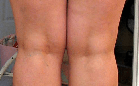 Varico sulle gambe
