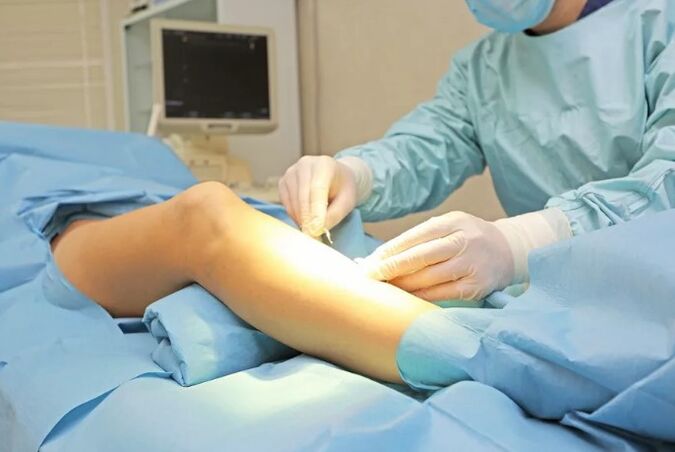 Operazione per la rimozione delle vene sulle gambe