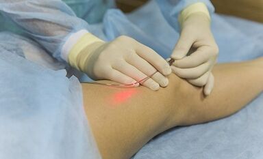 Trattamento delle vene varicose con un laser