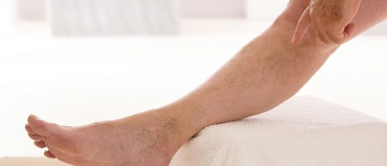 Vene varicose sulle gambe